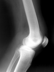 knee-x-ray-Mecklenburg-Iredell-Union-County-Workers-Compensation-Attorney-225x300