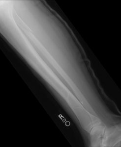 broken-leg-Medical-Malpractice-Charlotte-Monroe-Mooresville-Personal-Injury-Lawyers-246x300